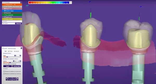 Custom Abutments - Image 4